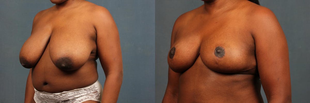 Reduction Before & After Gallery - Patient 142162 - Image 2