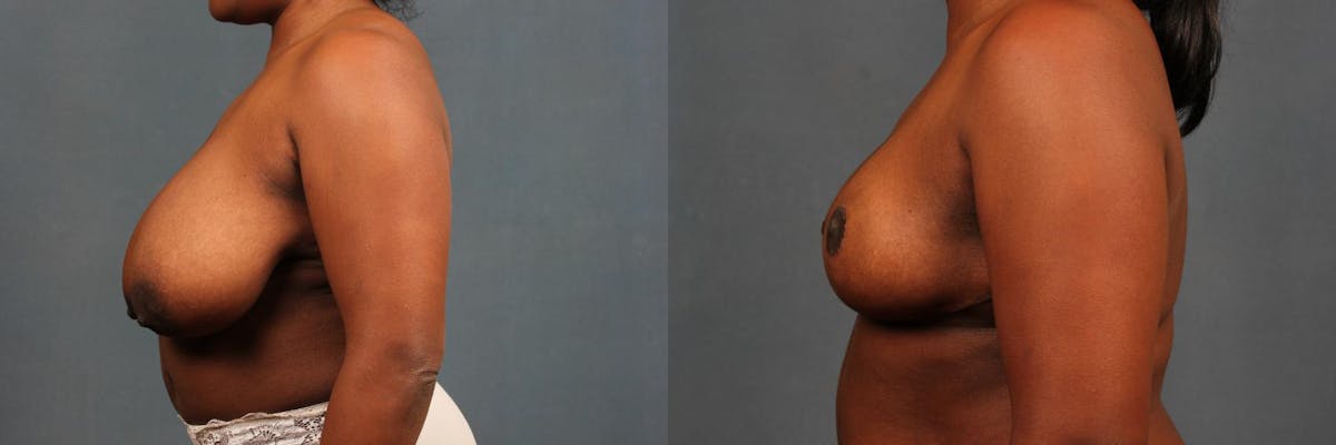 Reduction Before & After Gallery - Patient 142162 - Image 3