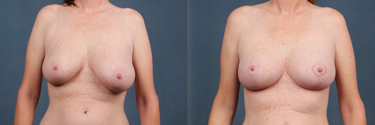 Reduction Before & After Gallery - Patient 271912 - Image 1