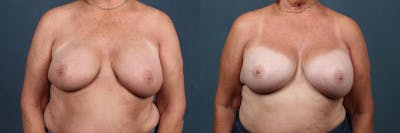 Revision Before & After Gallery - Patient 252961 - Image 1