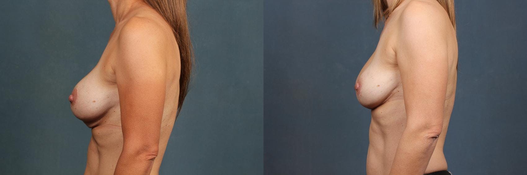 Revision Before & After Gallery - Patient 375564 - Image 2