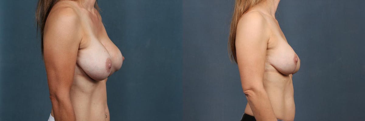 Revision Before & After Gallery - Patient 375564 - Image 4