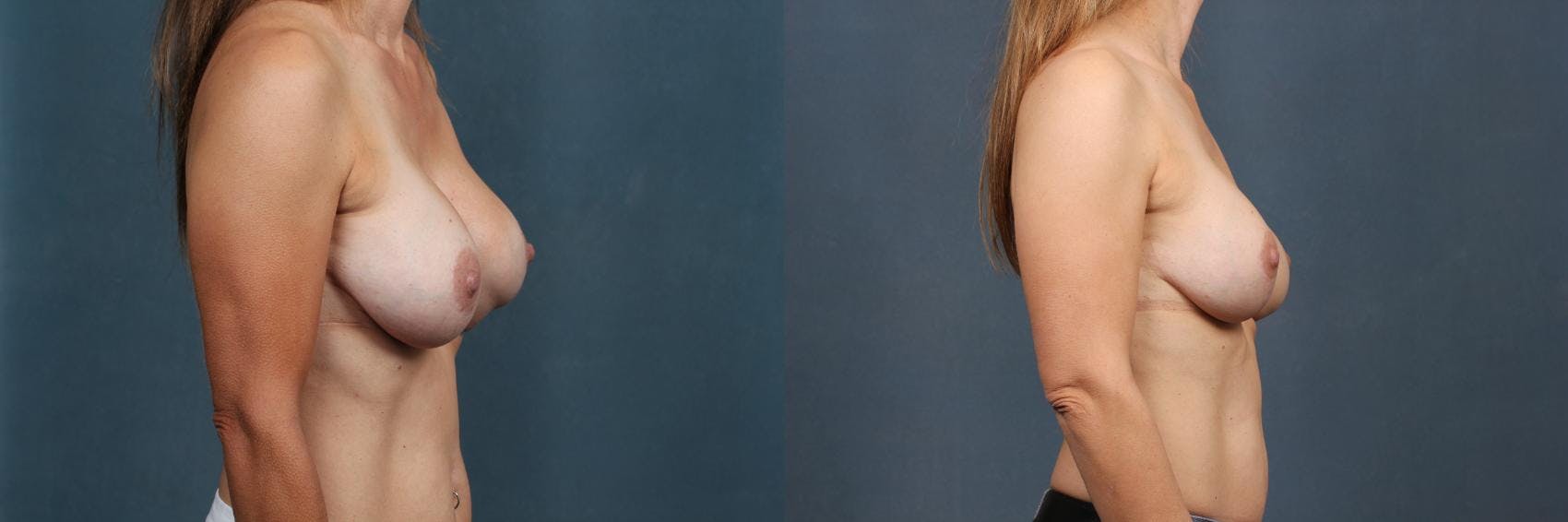 Revision Before & After Gallery - Patient 375564 - Image 4