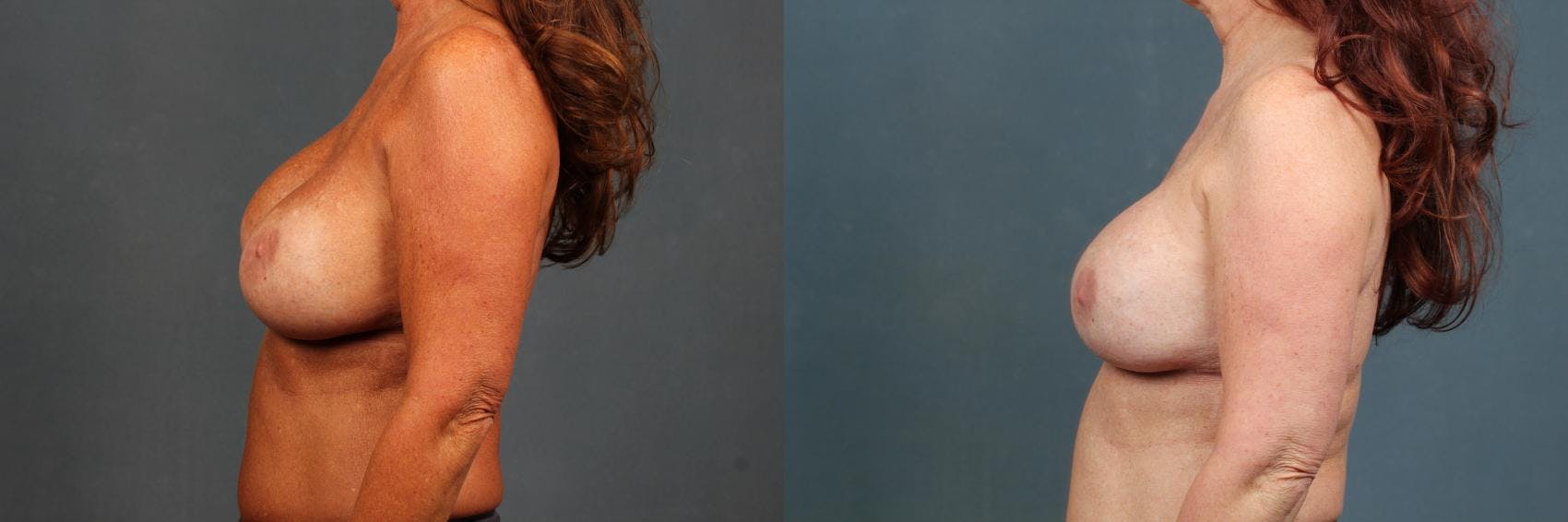 Revision Before & After Gallery - Patient 376648 - Image 2