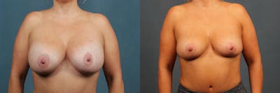 Revision Before & After Gallery - Patient 388781 - Image 1