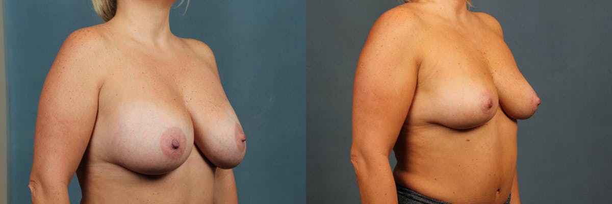 Revision Before & After Gallery - Patient 388781 - Image 2