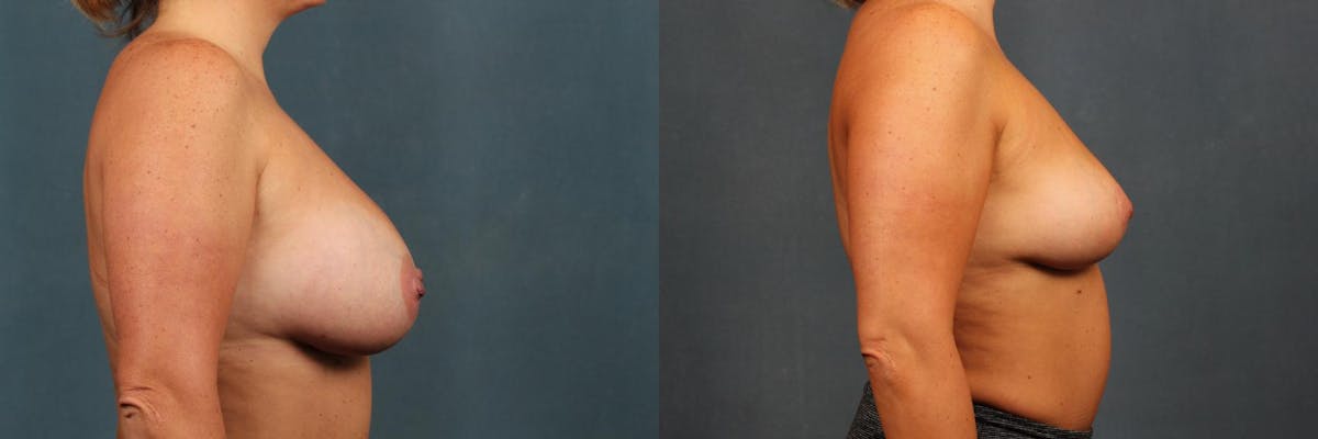 Revision Before & After Gallery - Patient 388781 - Image 3