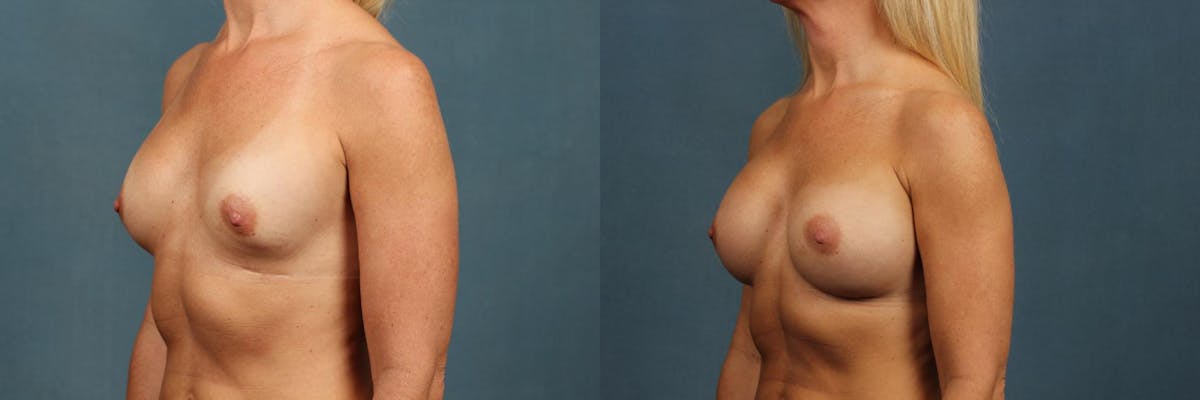 Revision Before & After Gallery - Patient 235666 - Image 2