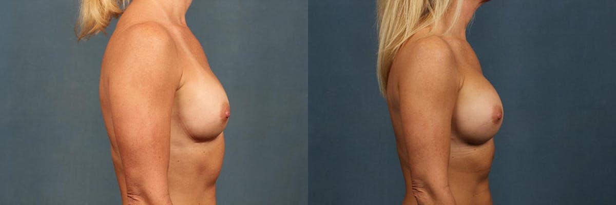 Revision Before & After Gallery - Patient 235666 - Image 3