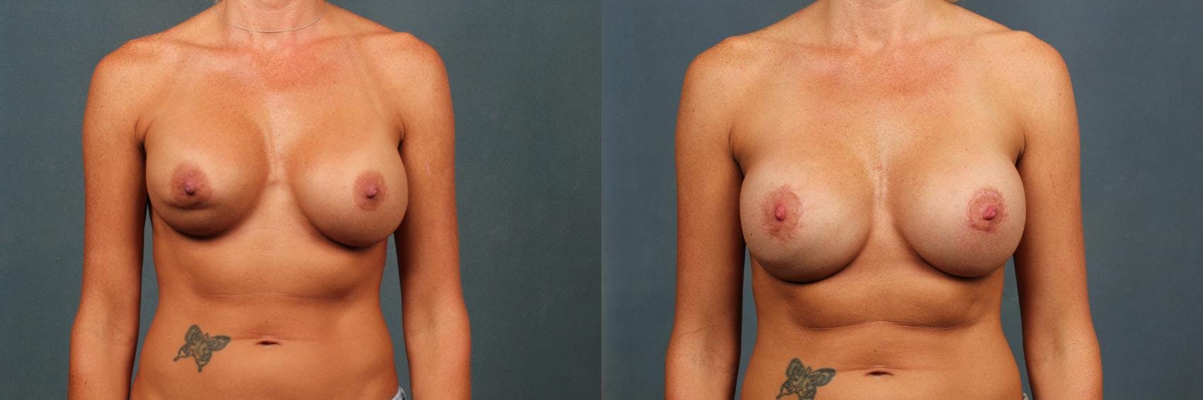 Revision Before & After Gallery - Patient 157518 - Image 1
