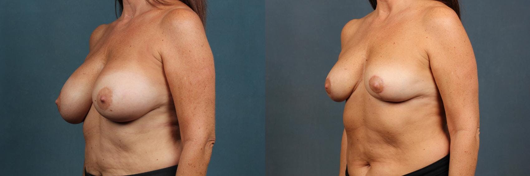 Revision Before & After Gallery - Patient 284898 - Image 2