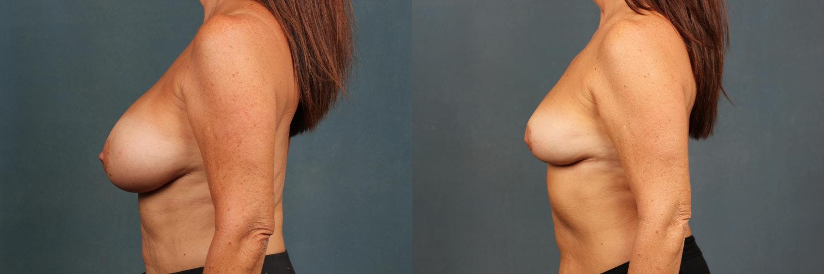 Revision Before & After Gallery - Patient 284898 - Image 3