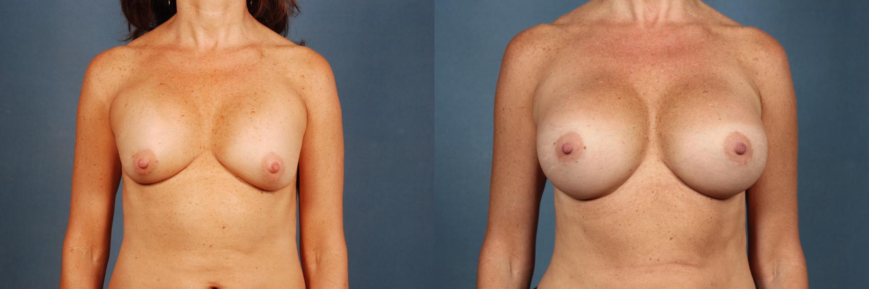 breast revision patient results
