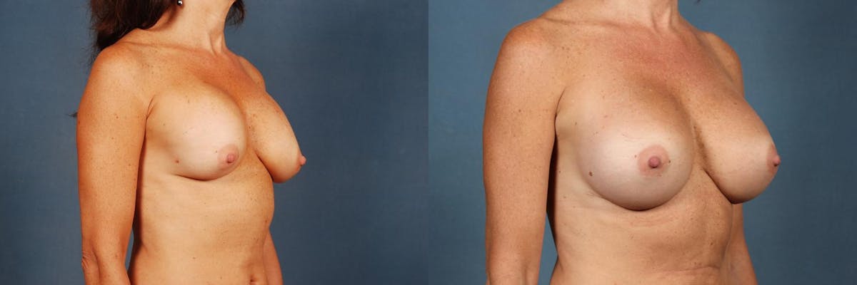 Revision Before & After Gallery - Patient 292813 - Image 2