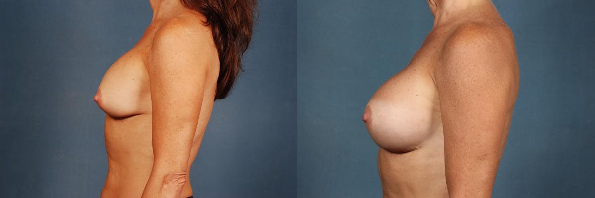 Revision Before & After Gallery - Patient 292813 - Image 3