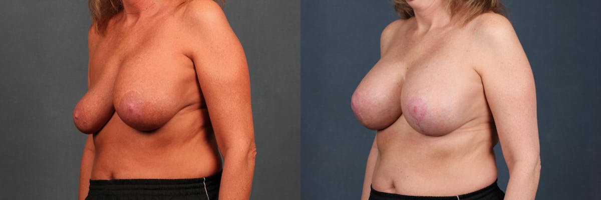 Revision Before & After Gallery - Patient 365196 - Image 2