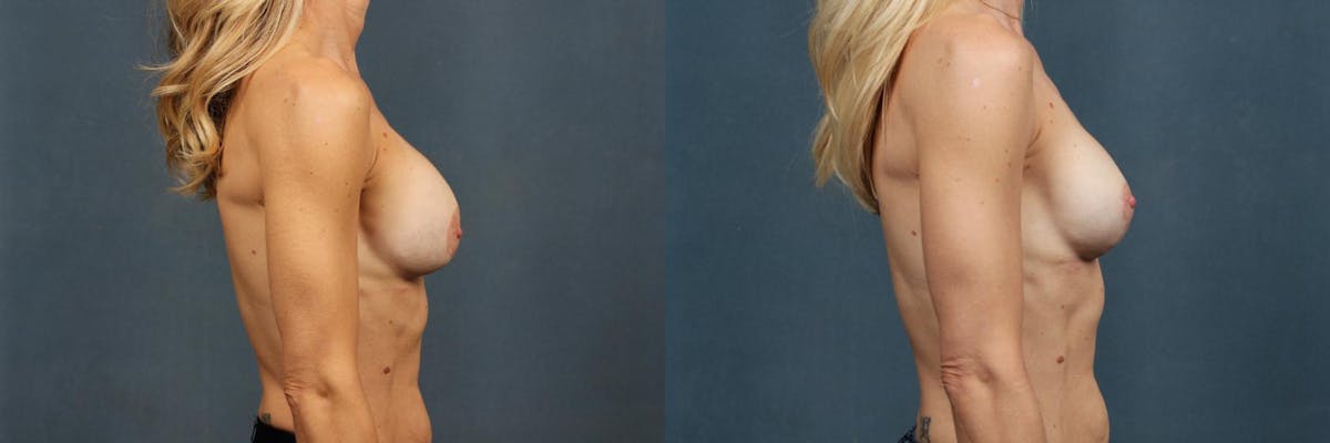 Revision Before & After Gallery - Patient 962266 - Image 5