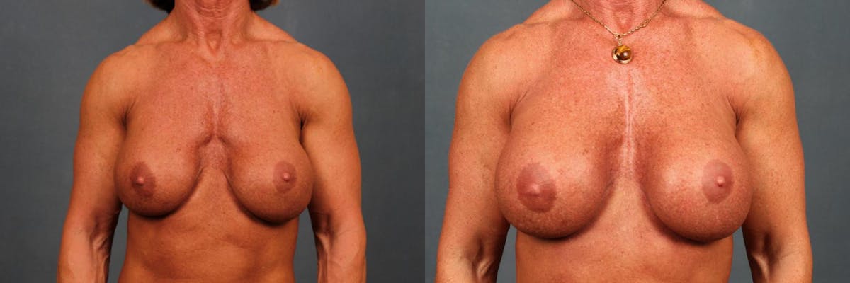 Revision Before & After Gallery - Patient 345874 - Image 1