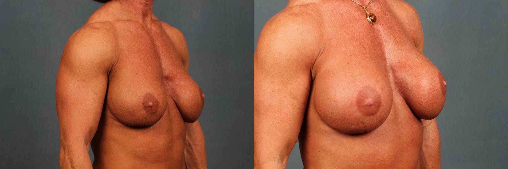 Revision Before & After Gallery - Patient 345874 - Image 2