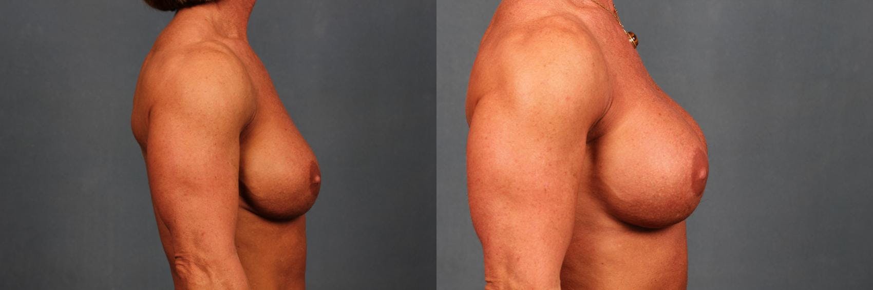 Revision Before & After Gallery - Patient 345874 - Image 3