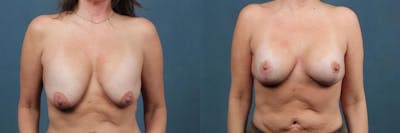 Revision Before & After Gallery - Patient 183986 - Image 1