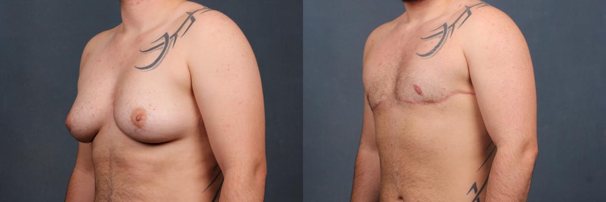 Top Surgery Before & After Gallery - Patient 189570 - Image 2