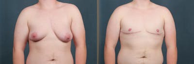 Top Surgery Before & After Gallery - Patient 190228 - Image 1