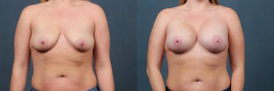 Lift Before & After Gallery - Patient 214260 - Image 1