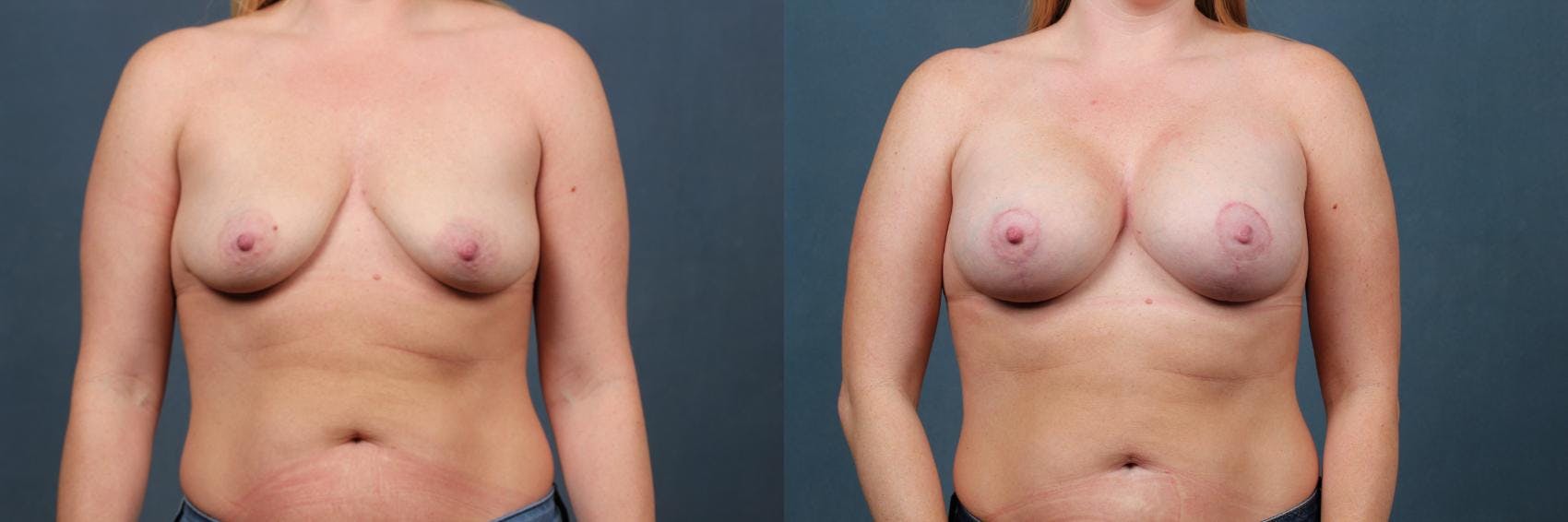 Lift Before & After Gallery - Patient 214260 - Image 1