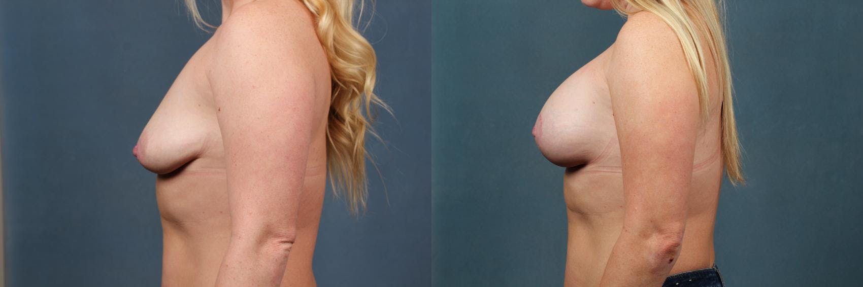 Lift Before & After Gallery - Patient 214260 - Image 3