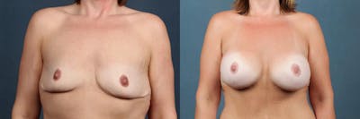 Lift Before & After Gallery - Patient 255568 - Image 1