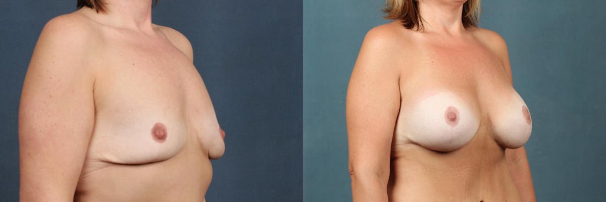 Lift Before & After Gallery - Patient 255568 - Image 2