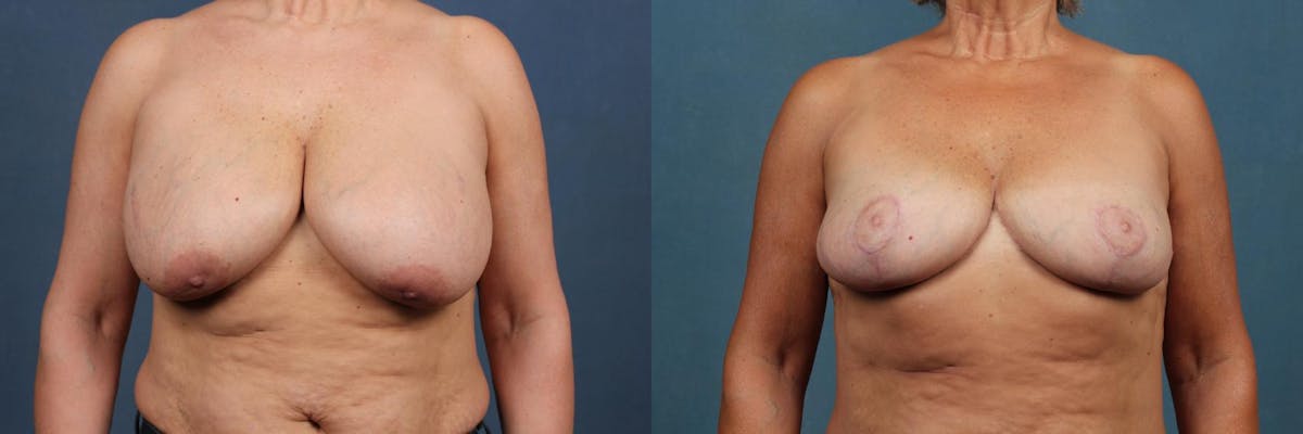Lift Before & After Gallery - Patient 324893 - Image 1