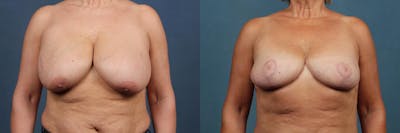 Lift Before & After Gallery - Patient 324893 - Image 1