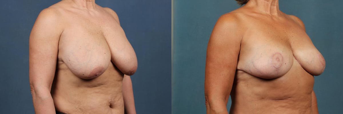 Lift Before & After Gallery - Patient 324893 - Image 2