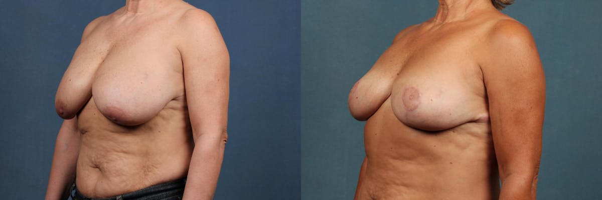 Lift Before & After Gallery - Patient 324893 - Image 3