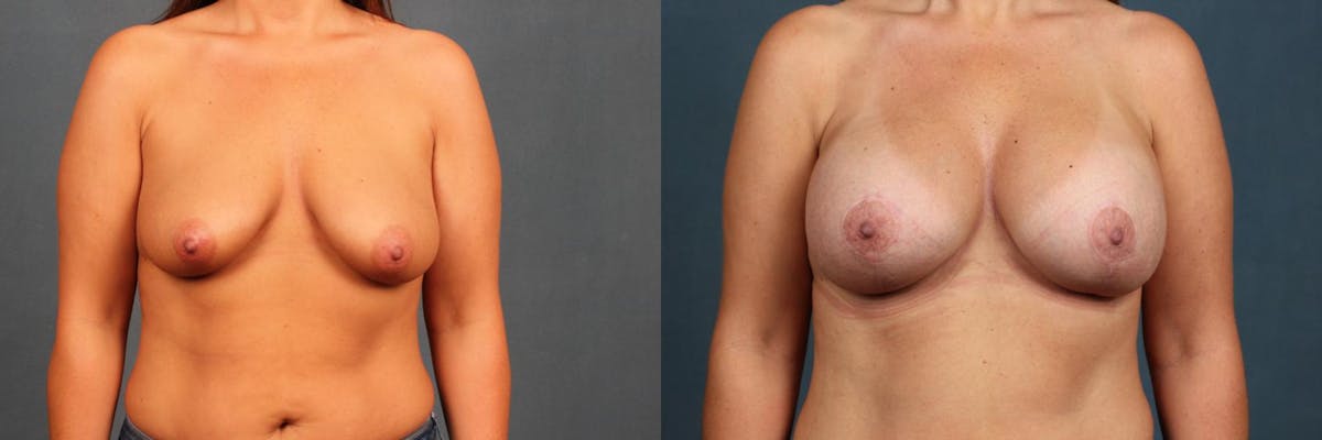Lift Before & After Gallery - Patient 245567 - Image 1