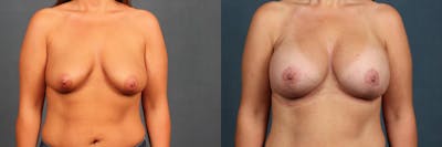 Lift Before & After Gallery - Patient 245567 - Image 1
