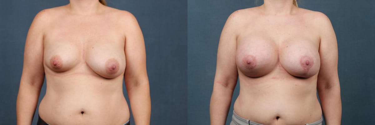 Lift Before & After Gallery - Patient 248926 - Image 1