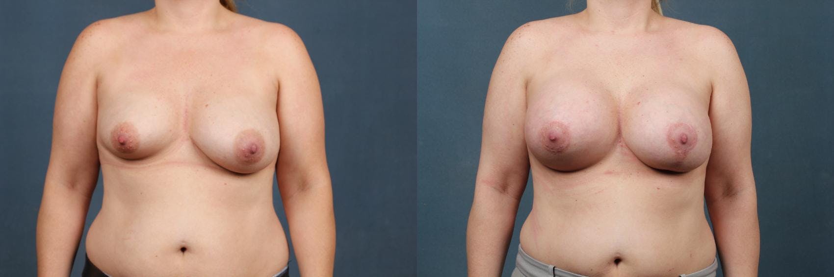 Lift Before & After Gallery - Patient 248926 - Image 1