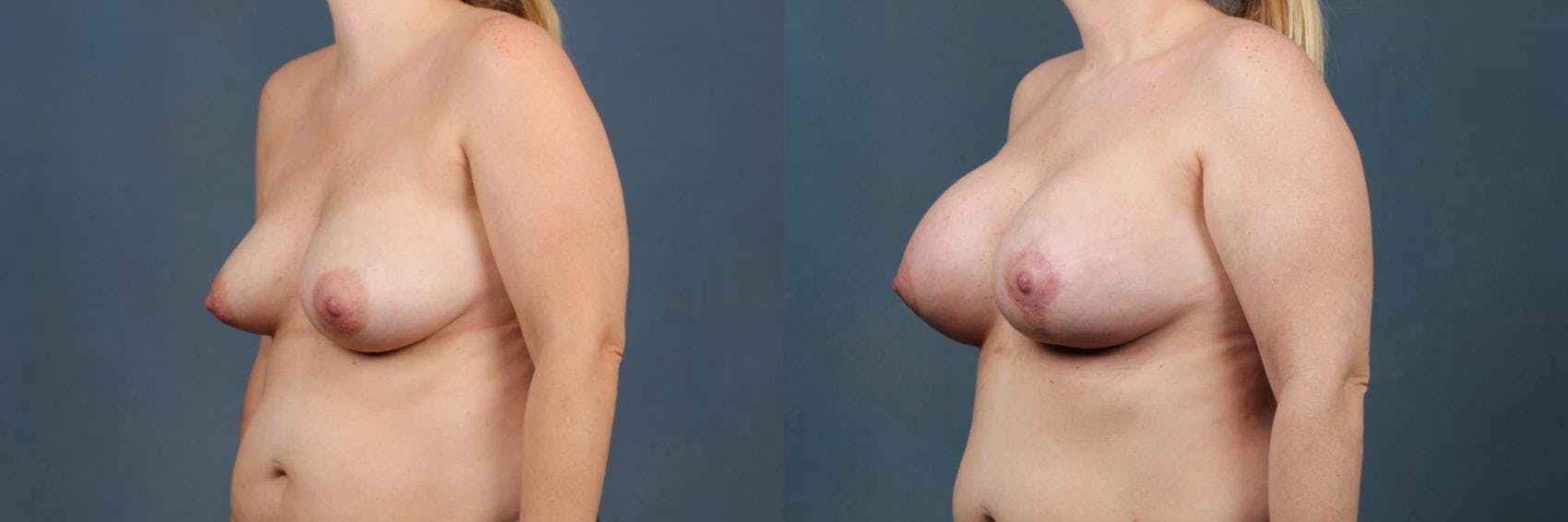Lift Before & After Gallery - Patient 248926 - Image 2