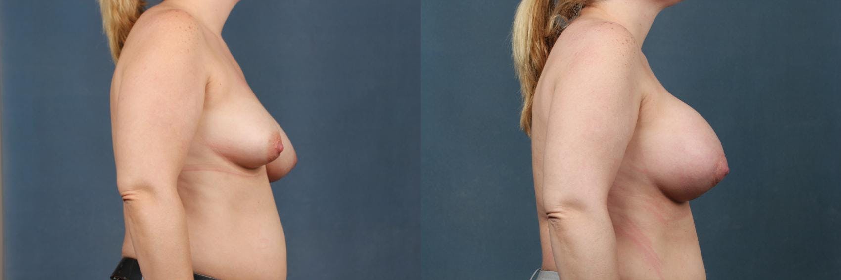 Lift Before & After Gallery - Patient 248926 - Image 3