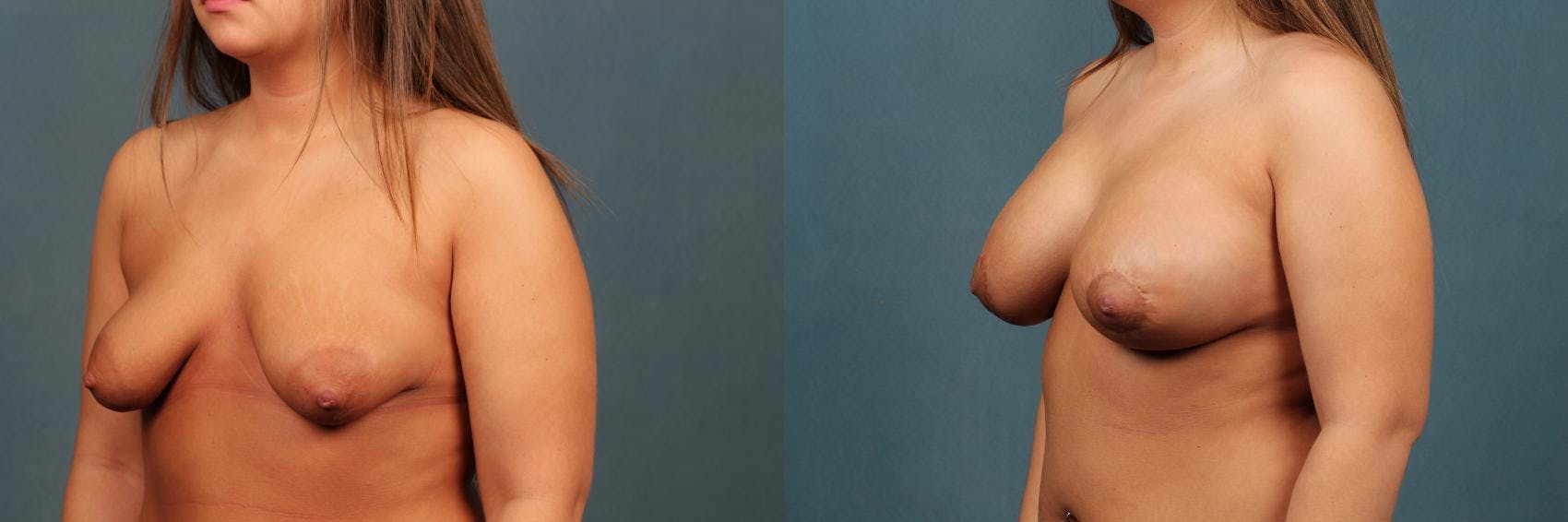 Lift Before & After Gallery - Patient 110098 - Image 2