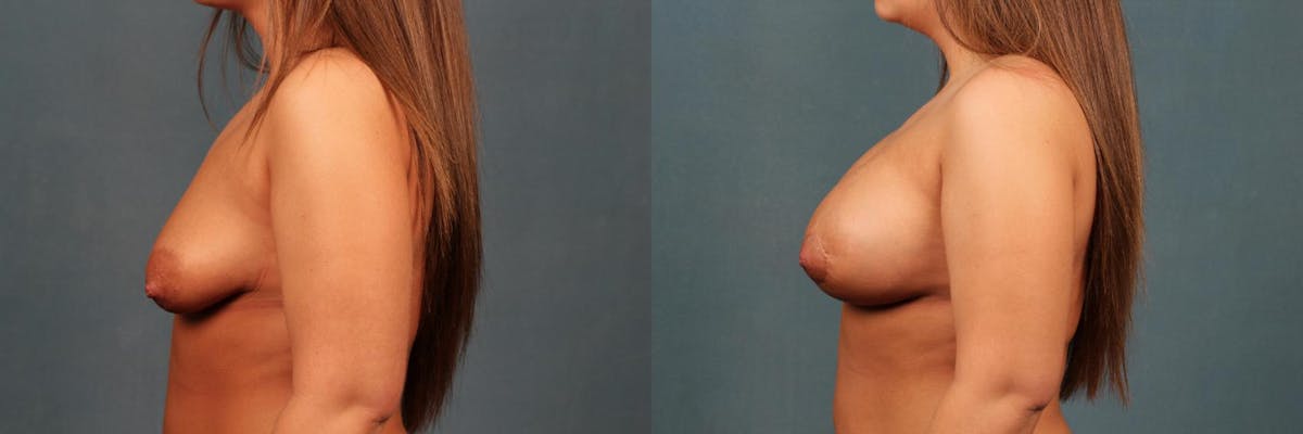Lift Before & After Gallery - Patient 110098 - Image 3