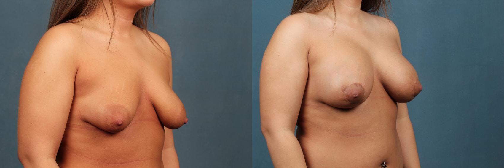 Lift Before & After Gallery - Patient 110098 - Image 4