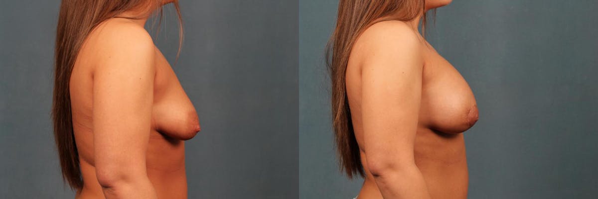 Lift Before & After Gallery - Patient 110098 - Image 5