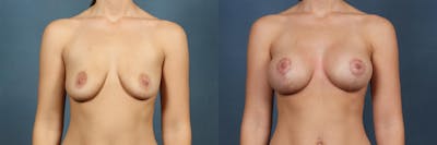 Lift Before & After Gallery - Patient 264363 - Image 1
