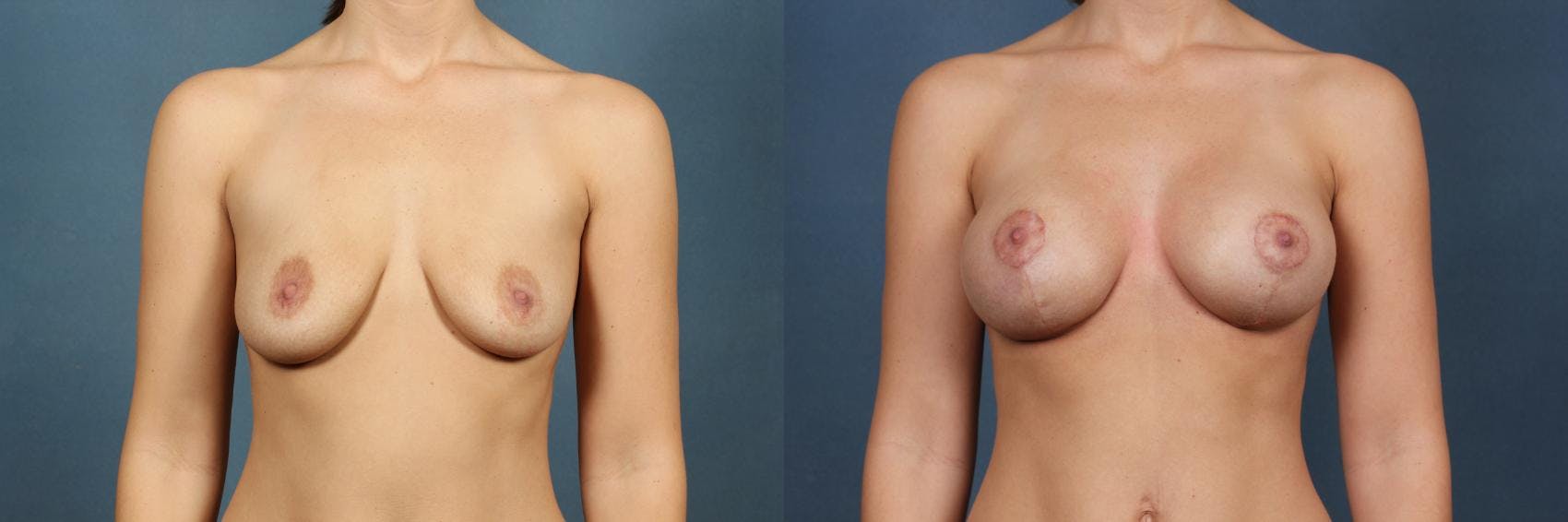 Lift Before & After Gallery - Patient 264363 - Image 1