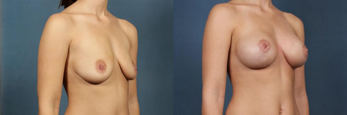 Lift Before & After Gallery - Patient 264363 - Image 2