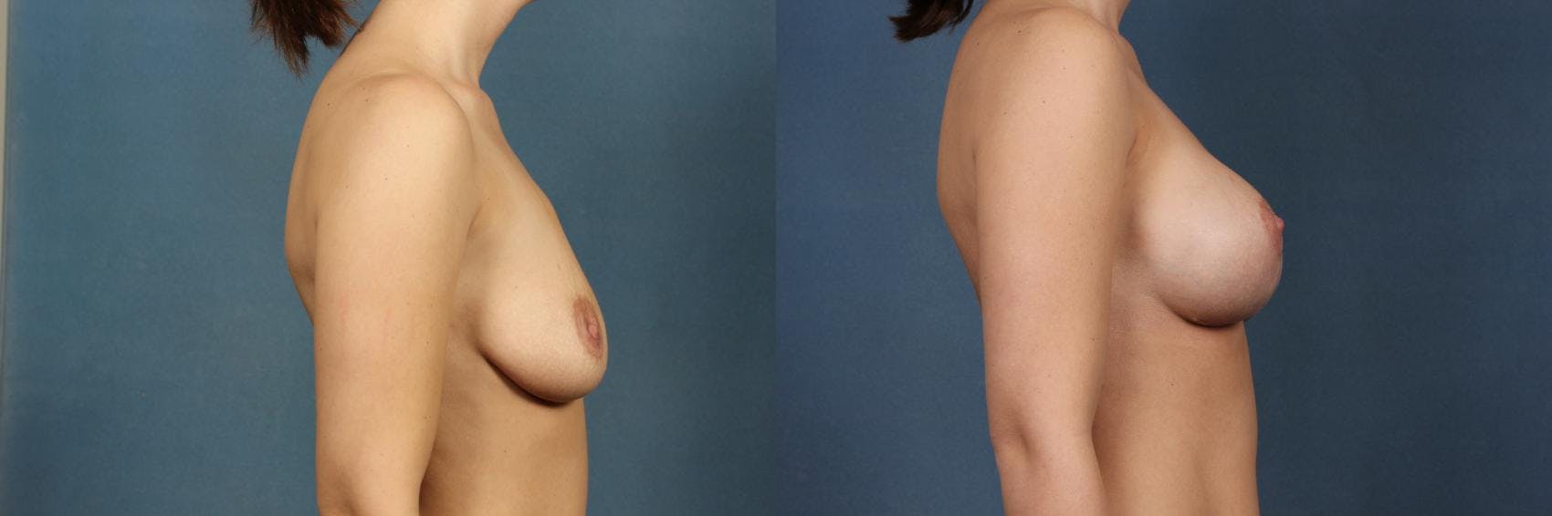Lift Before & After Gallery - Patient 264363 - Image 3